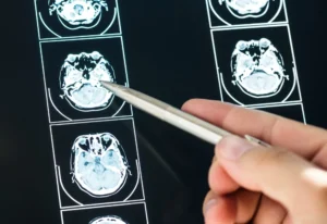 Primeiro plano de uma ressonância magnética cerebral com cortes visíveis e contraste para avaliar um AVC.