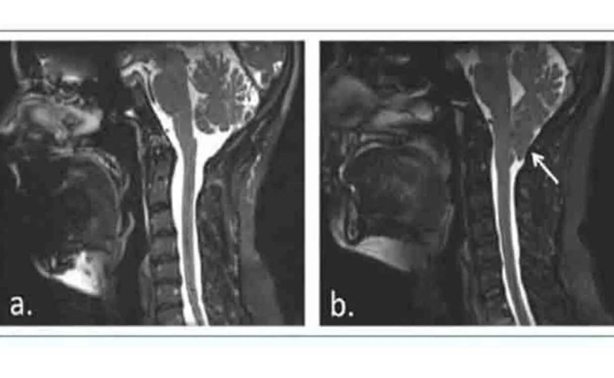 Caso clínico de malformação de Chiari tipo I