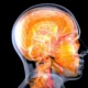 Infográfico 3D do cérebro humano semitransparente com lóbulos e vasos, para ilustrar a Doença de corpos de Lewy.