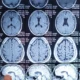 Ressonâncias magnéticas cerebrais em grade com cortes transversais e etiquetas de orientação; áreas claras ou escuras que mostram tecido.