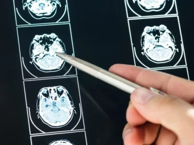 Acidente vascular cerebral (AVC): o que é, tipos e possíveis sequelas