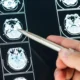 Acidente vascular cerebral (AVC): o que é, tipos e possíveis sequelas