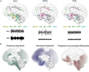 An der Regulation des Schlaf-Wach-Zyklus beteiligte neuronale Netzwerke und Verteilung der Pathologie bei verschiedenen neurodegenerativen Erkrankungen.