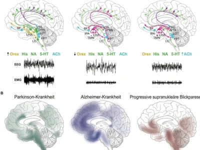 An der Regulation des Schlaf-Wach-Zyklus beteiligte neuronale Netzwerke und Verteilung der Pathologie bei verschiedenen neurodegenerativen Erkrankungen.