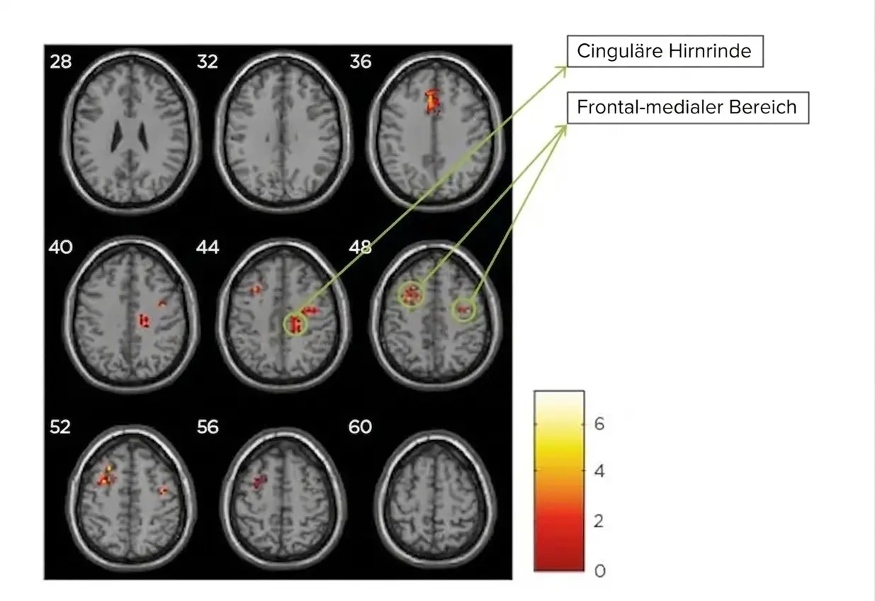 Gehirn-MRT mit fMRT zeigt Veränderungen der grauen Substanz nach kognitiver Rehabilitation bei MS; hervorgehoben sind der cinguläre Kortex und der mediale frontale Bereich.