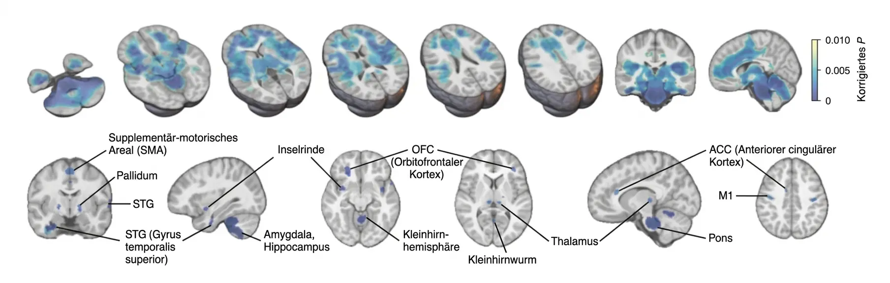 Überleben in Abhängigkeit von der Konnektivität des Tumors mit dem DMG-Netzwerk.