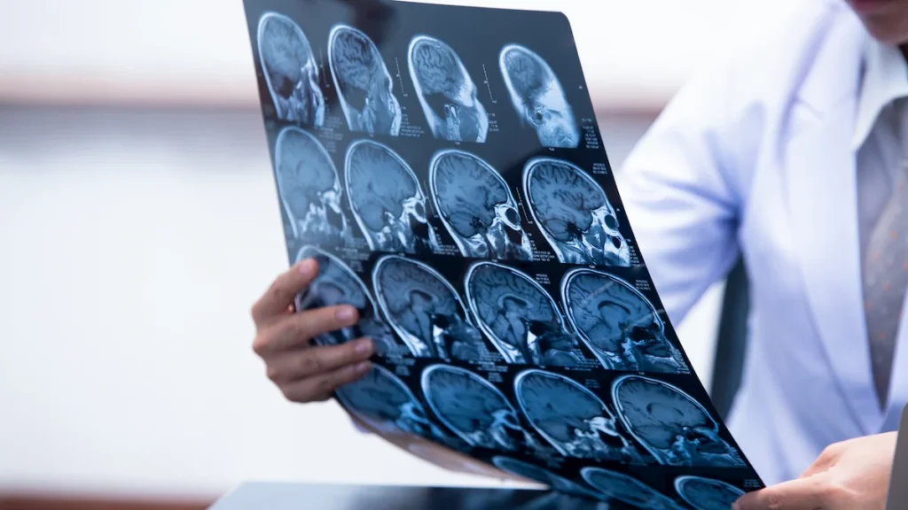 Personne tenant des radiographies et/ou des images IRM du cerveau, organisées en rangées pour évaluation clinique.