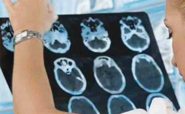 NeuronUP vous rapproche du dommage cérébral acquis (1)