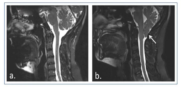 Dos imágenes RM en vista lateral de Chiari tipo I; izquierda sin anomalías y derecha con flecha señalando una variación.