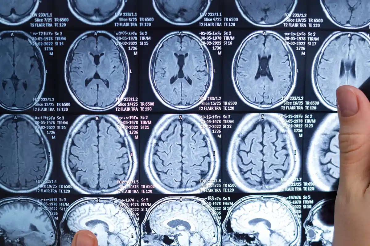 Serie di immagini MRI del cervello presentate in pannelli, evidenziando anatomia cerebrale, angolazioni diverse.
