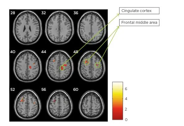 Cambiamenti neuropsicologici e nel volume della sostanza grigia nei pazienti con sclerosi multipla