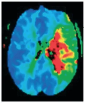 Schermata dell'articolo sulla penombra ischemica e neuroriabilitazione dopo Ictus, mostra il titolo nell'intestazione.