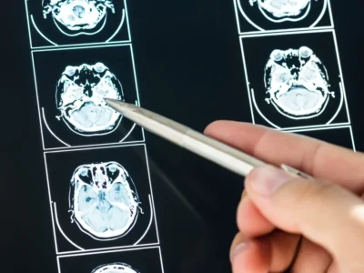 Accidente cerebrovascular o ACV: qué es, tipos y posibles secuelas. Cerebro tras sufrir accidente cerebrovascular (ACV.