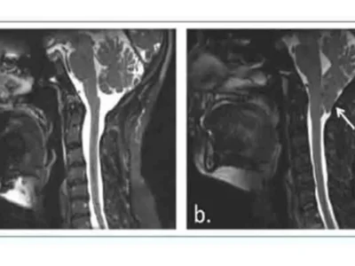 Caso clínico de malformación de Chiari tipo I