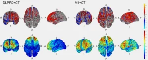 Estudio de viabilidad de la neuromodulación y el entrenamiento cognitivo para la fatiga post-COVID